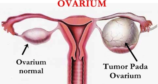 Waspada Kanker Ovarium, Gejala dan Faktor Resiko