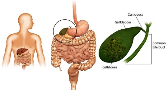 Batu Empedu. Gejala, Penyebab, dan Pengobatan