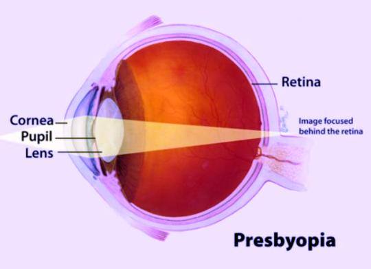 Presbiopi. Gejala, Penyebab, Cara Mengatasi