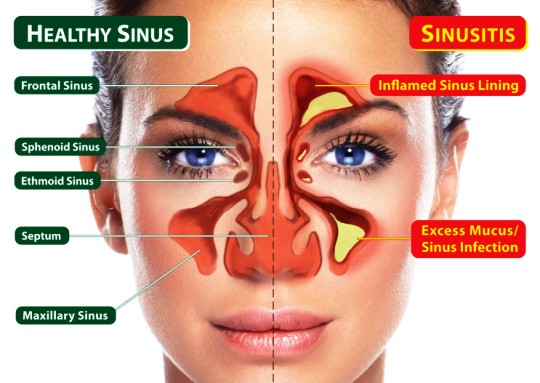 Sinusitis: Gejala, Penyebab, Cara Mengatasi