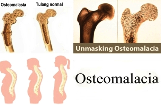 Tulang Rapuh (Osteomalasia): Definisi, Gejala, Penyebab, Pengobatan