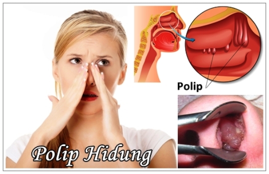 Polip Hidung: Penyebab, Gejala, Pengobatan