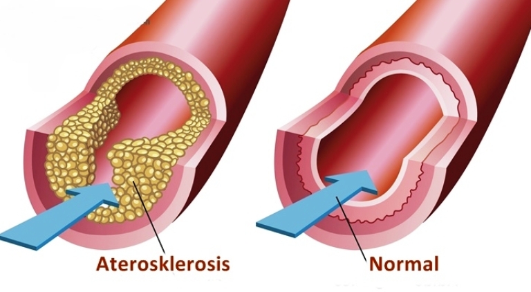 penyumbatan arteri