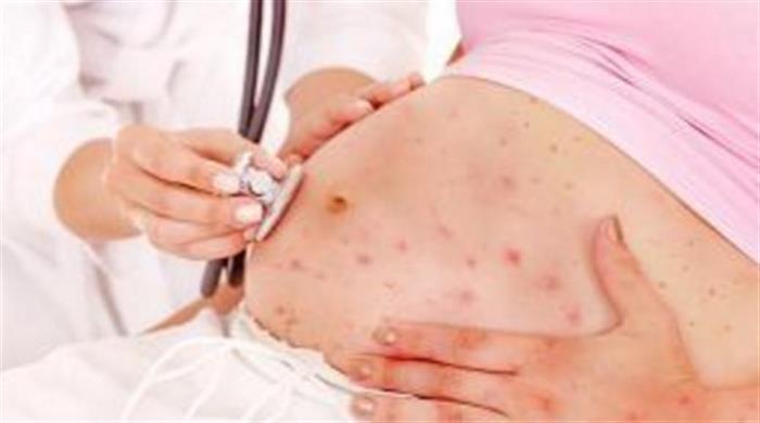 Penyakit Rubella Pada Wanita Hamil Akibatkan Kelainan Janin