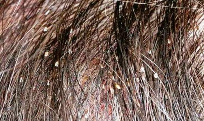 Cara Menghilangkan Kutu Rambut dan Telurnya Mudah Cepat dengan Cepat 1 Hari